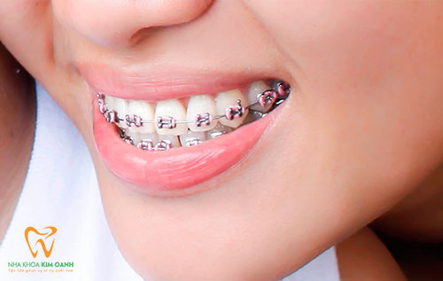 Tại sao lựa chọn công nghệ niềng răng Invisalign để chỉnh nha?