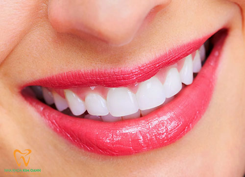 Răng toàn sứ thẩm mỹ Ceramill
